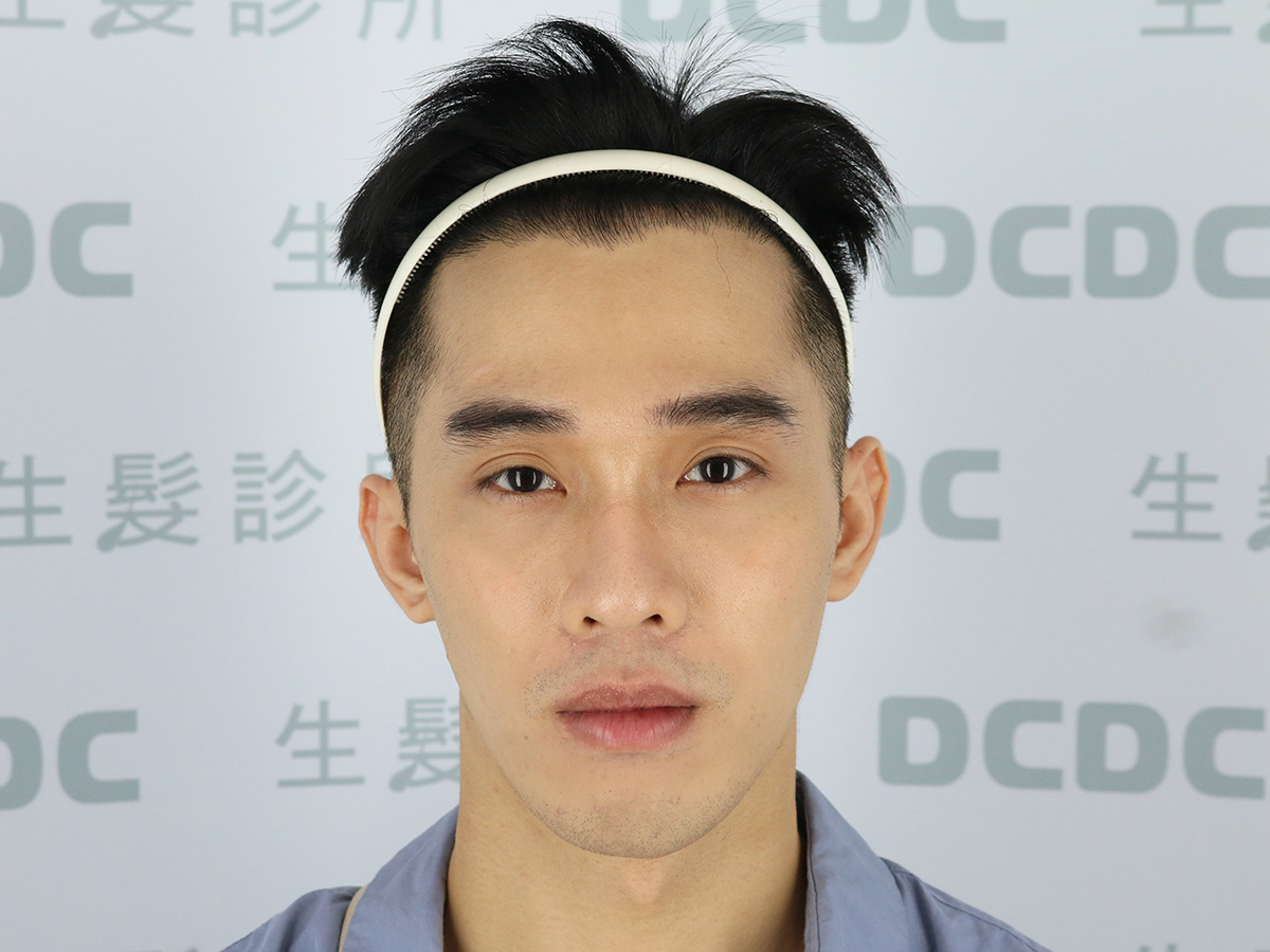 DCDC生髮診所男性髮際線植髮術後
