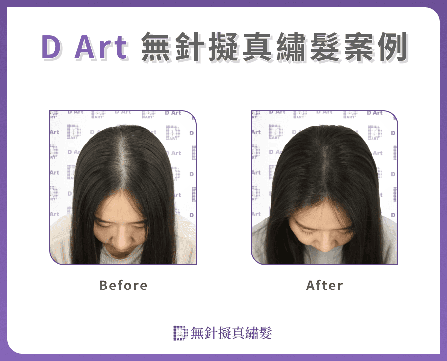 DCDC生髮診所：D Art 無針擬真繡髮案例