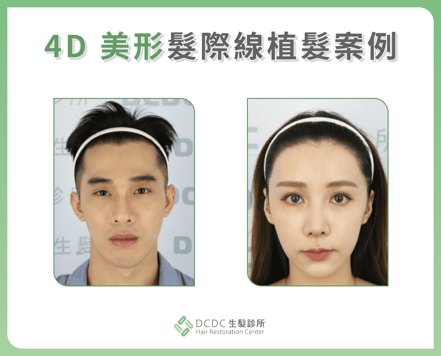 DCDC生髮診所：4D 美形髮際線植髮案例