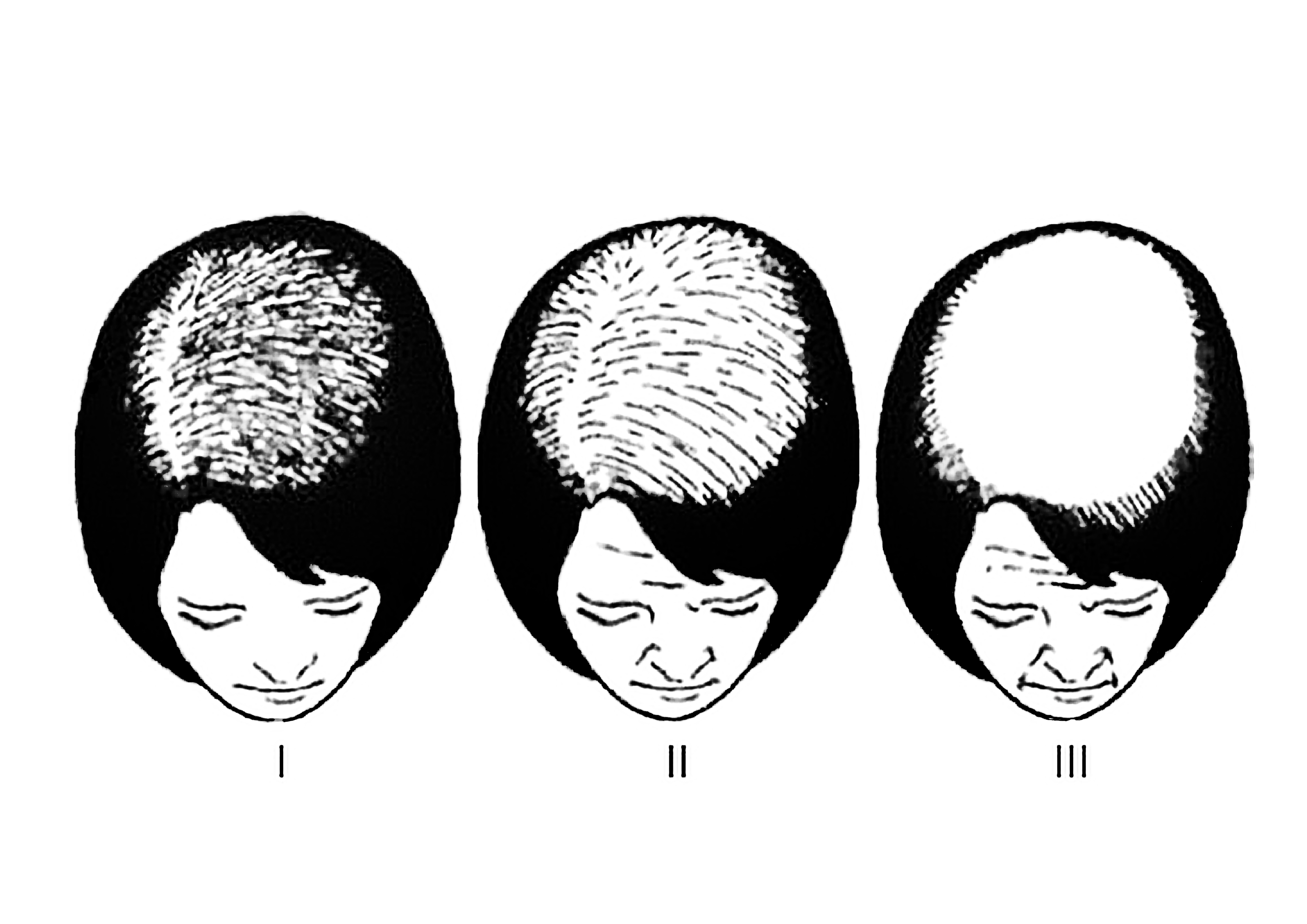 女性雄性禿分類
