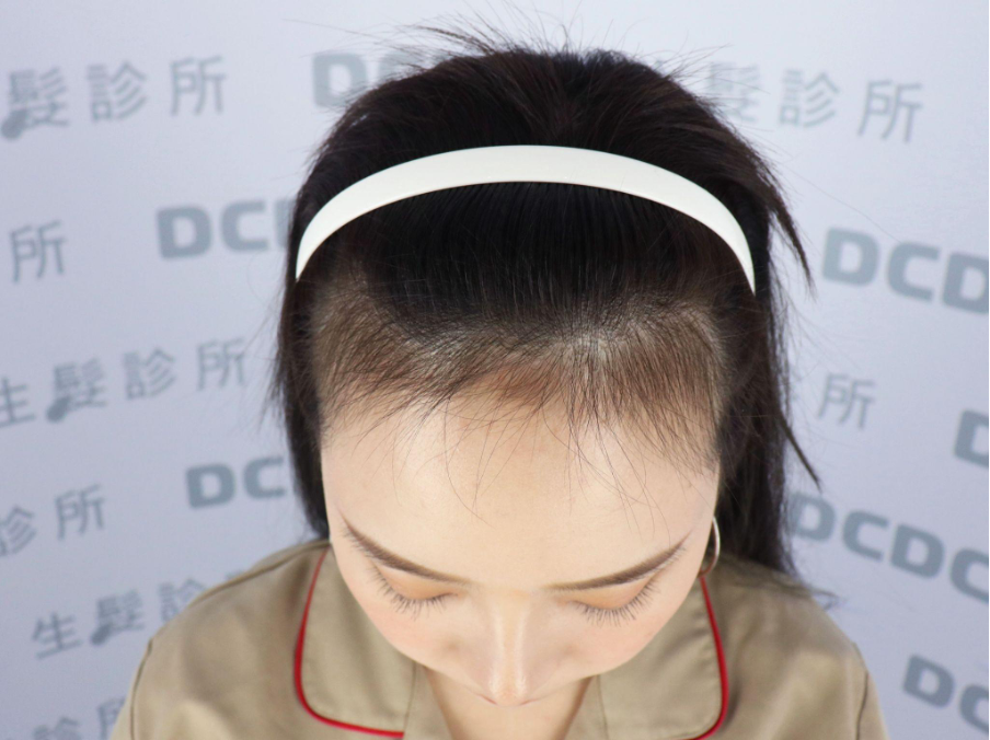 DCDC生髮診所Rina髮際線植髮術前