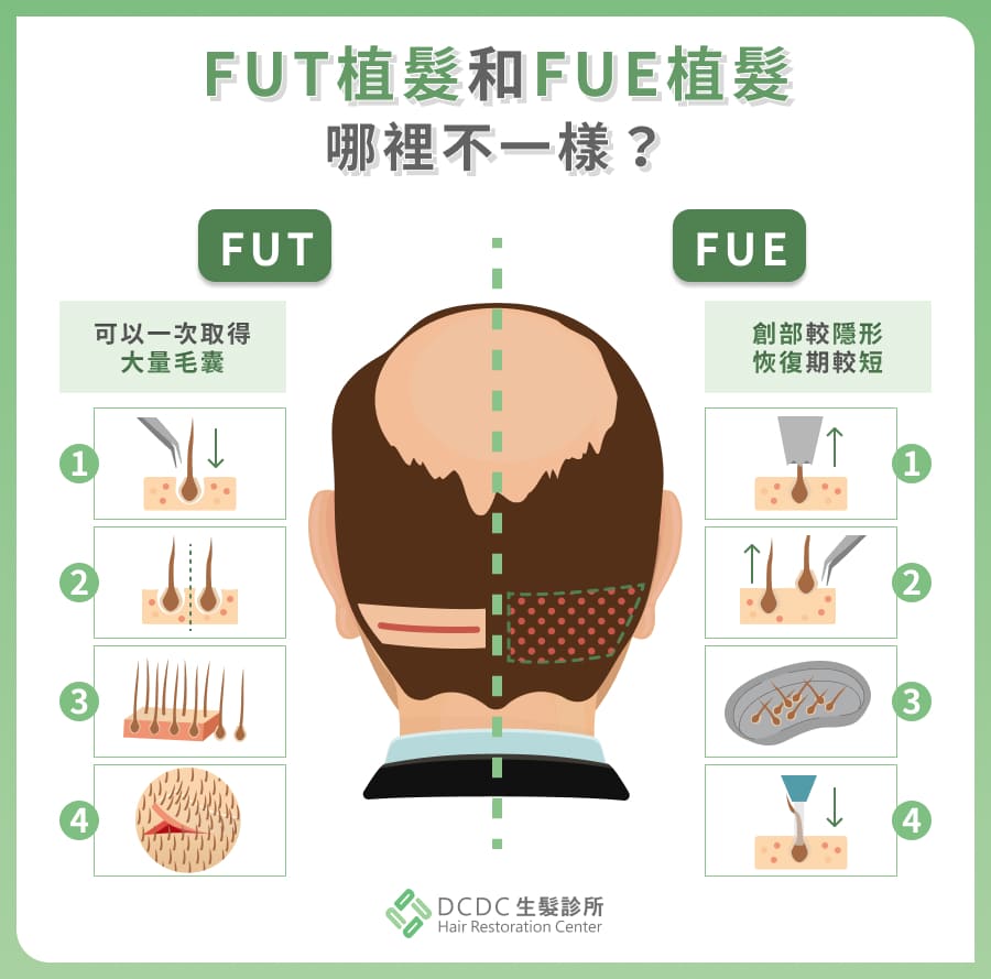 FUT 植髮和 FUE 植髮的不同  FUT植髮、FUE植髮的圖示