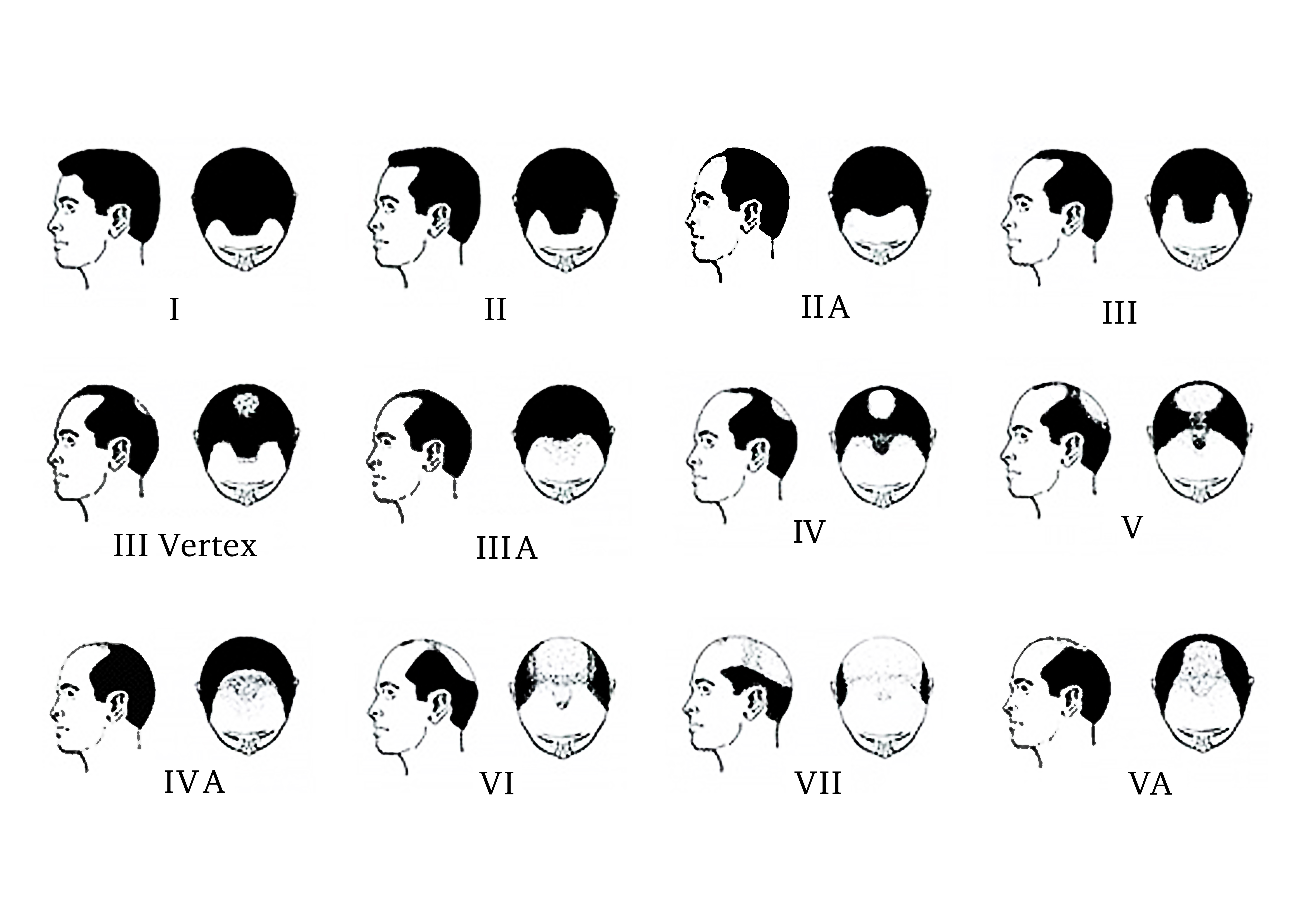 男性雄性禿分類